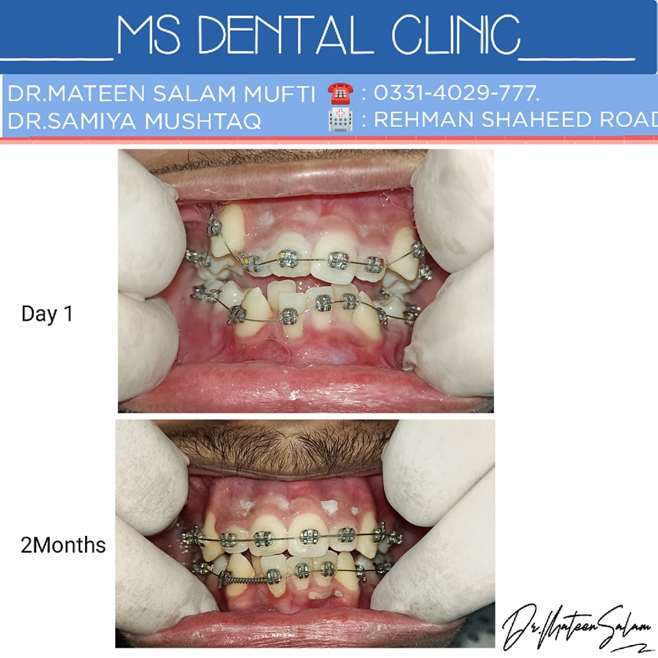 Braces case progress from Day 1 to 2 months at MS Dental Clinic