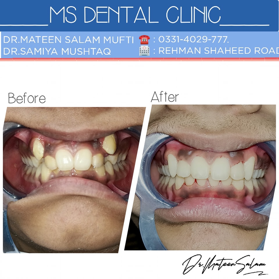 Completed orthodontic case before and after