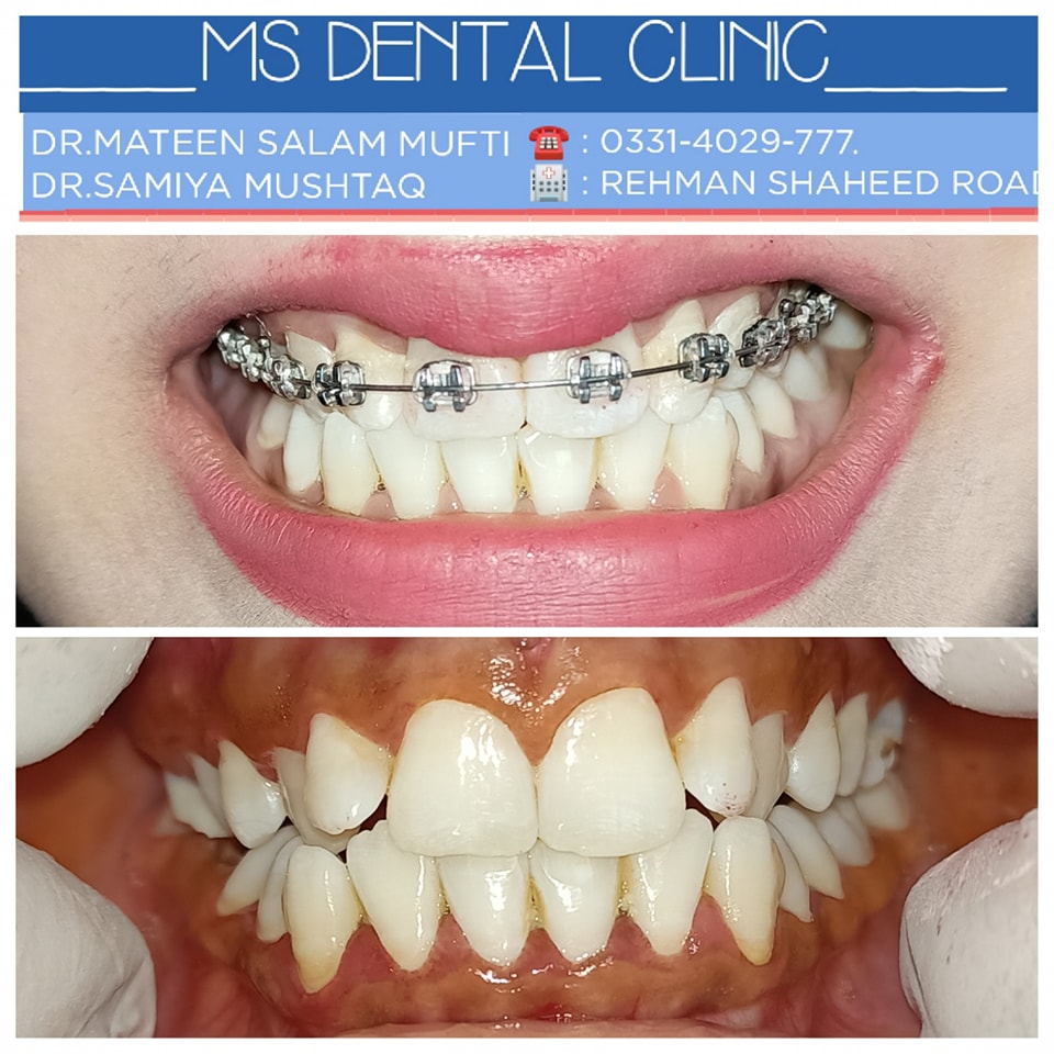 Full arch dental implants before and after