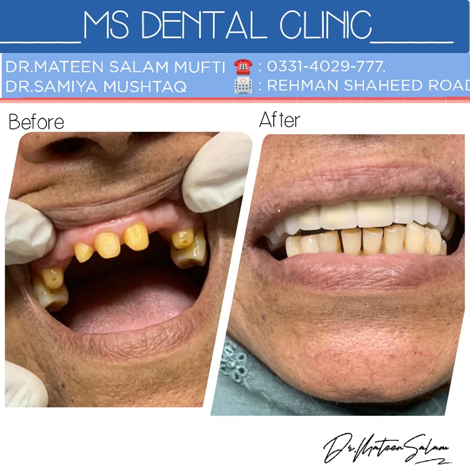 Root canal and crown restoration before and after