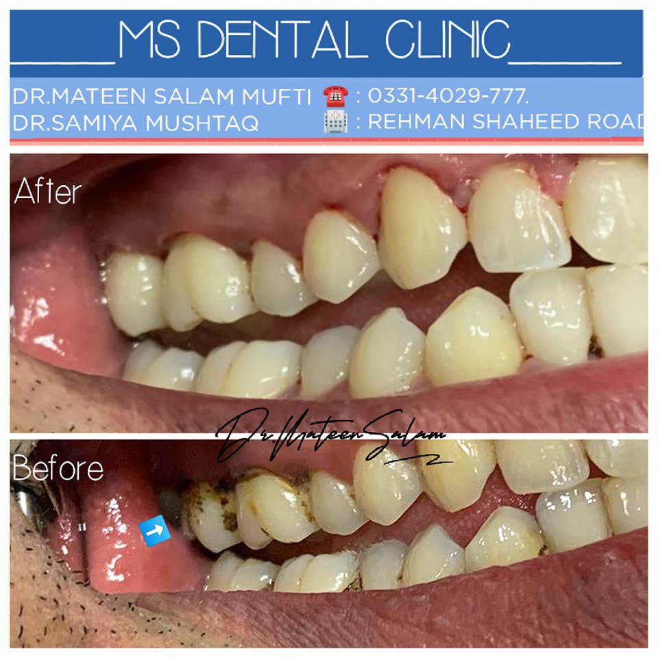 Scaling and deep clean before and after