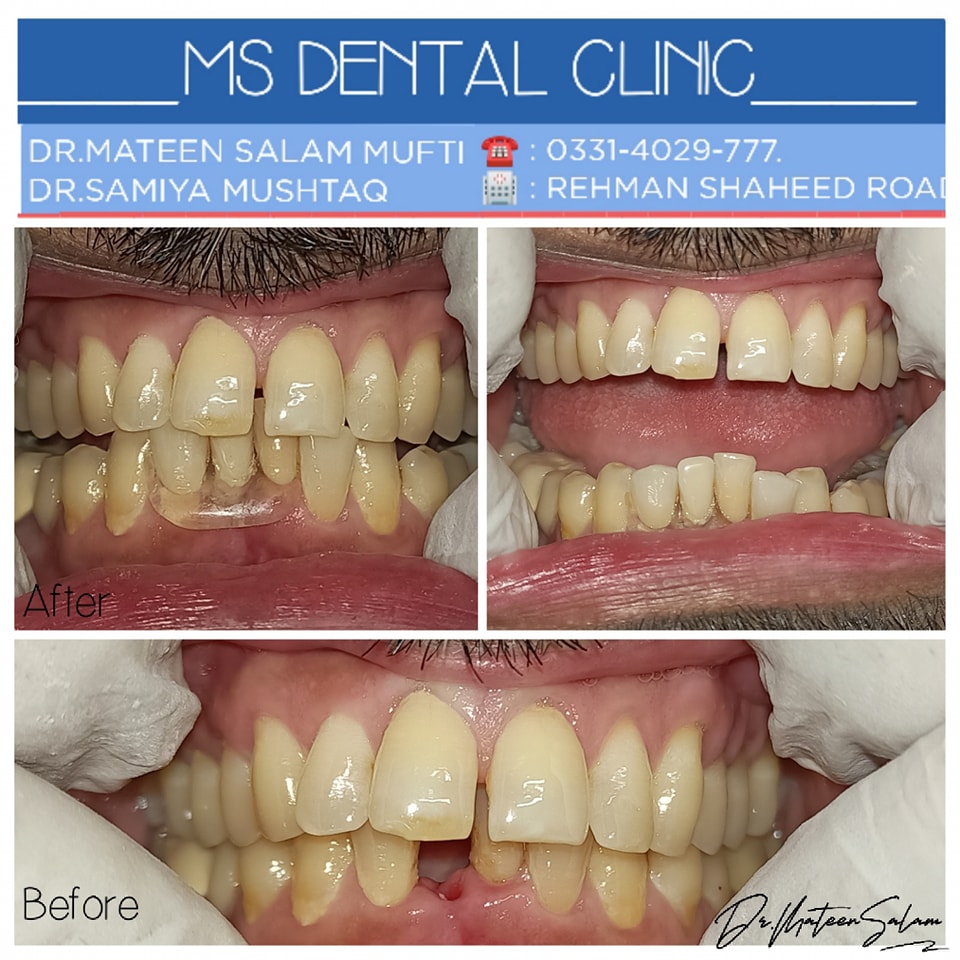 Zirconia crown before and after on front tooth